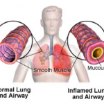 Upper Respiratory Infection