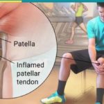 My first running injury – Patella Tendinitis