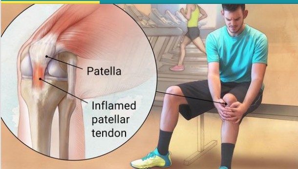 Patella Tendinitis